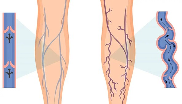 Horse Chestnut Extract Benefits Horse Chestnut Extract Benefits