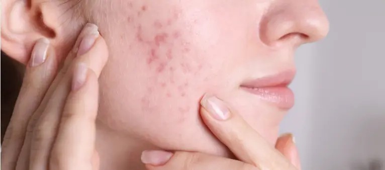 White Willow Bark Extract For Skin White Willow Bark Extract For Skin